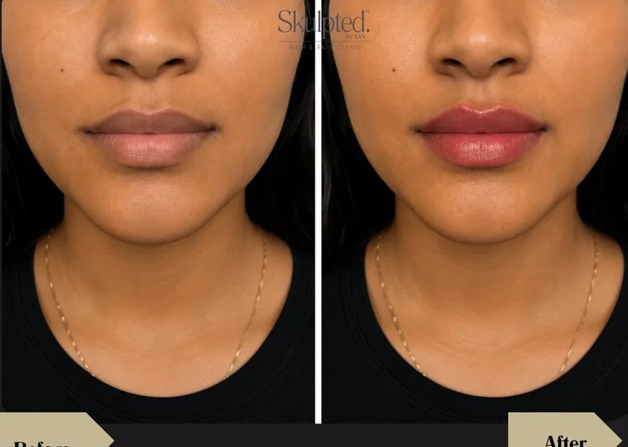 Lip blush result before and after — Skulpted by Kan