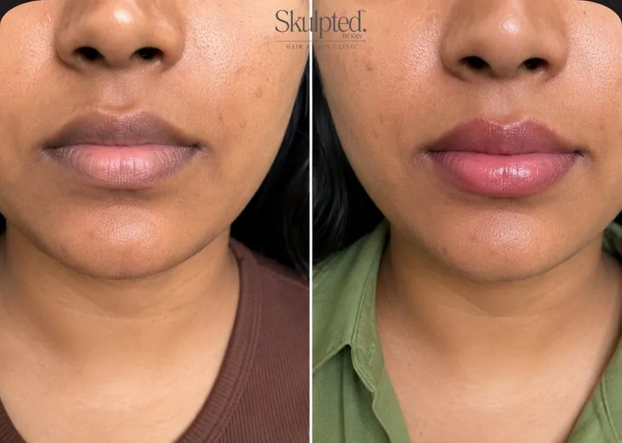 Lip blush before and after on deeper skin tone — Skulpted by Kan